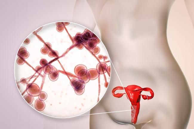 Quelles sont les causes d'une mycose vaginale ?